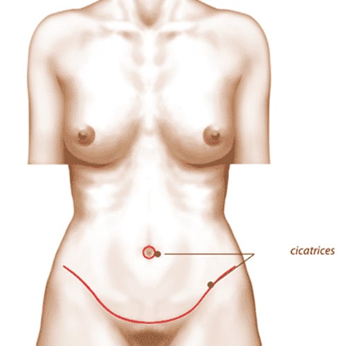 abdominoplastie cicatrices douleur chirurgie plastique paris docteur jerry levy chirurgien plasticien paris