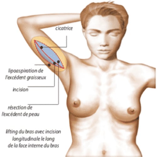 chirurgie des bras cicatrice brachioplastie photos chirurgie plastique paris docteur jerry levy chirurgien plasticien paris