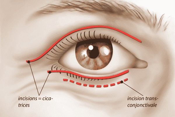 chirurgie poche sous les yeux blepharoplastie superieures et inferieure cicatrices chirurgie esthetique visage paris docteur jerry levy chirurgien esthetique paris