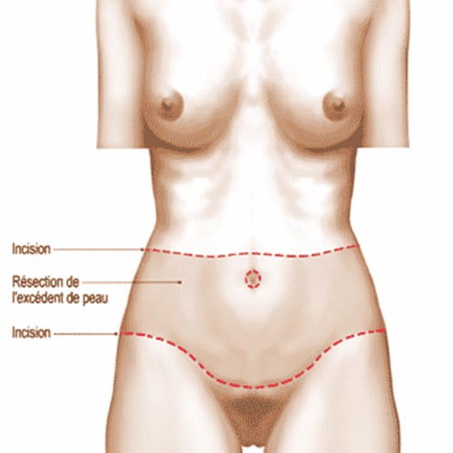 convalescence apres bodylift cicatrice chirurgie plastique paris docteur jerry levy chirurgien plasticien paris