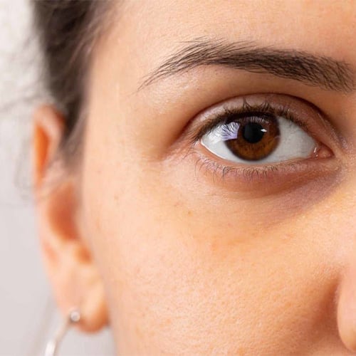 correction cernes acide hyaluronique medecine esthetique visage paris docteur jerry levy chirurgien esthetique paris