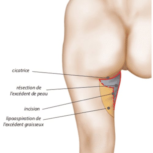 lifting cuisse cicatrice cruroplastie interne chirurgie plastique paris docteur jerry levy chirurgien plasticien paris