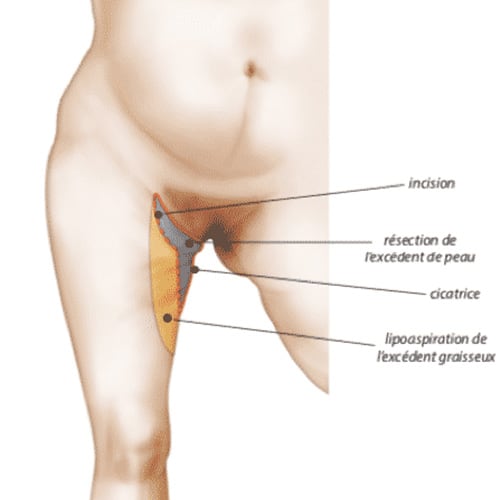 lifting cuisse cicatrice cruroplastie mixte chirurgie plastique paris docteur jerry levy chirurgien plasticien paris