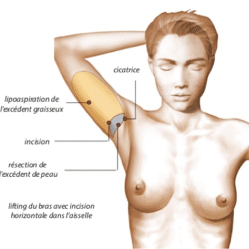 lifting des bras cicatrice brachioplastie cicatrice aisselle chirurgie plastique paris docteur jerry levy chirurgien plasticien paris