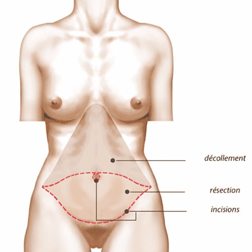 operation du ventre cicatrice abdominoplastie paris definition chirurgie plastique paris docteur jerry levy chirurgien plasticien paris