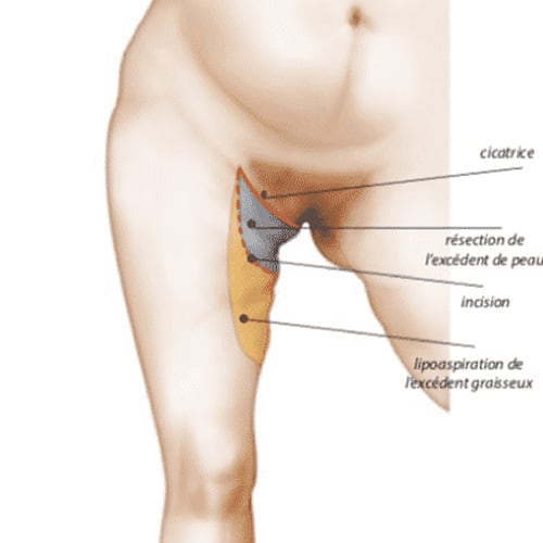 operation lifting cuisse cicatrice cruroplastie chirurgie plastique paris docteur jerry levy chirurgien plasticien paris