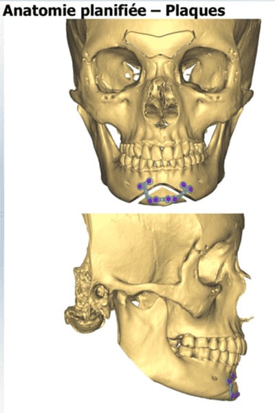 prix genioplastie menton anatomie planifiee chirurgie esthetique visage paris docteur jerry levy chirurgien esthetique paris