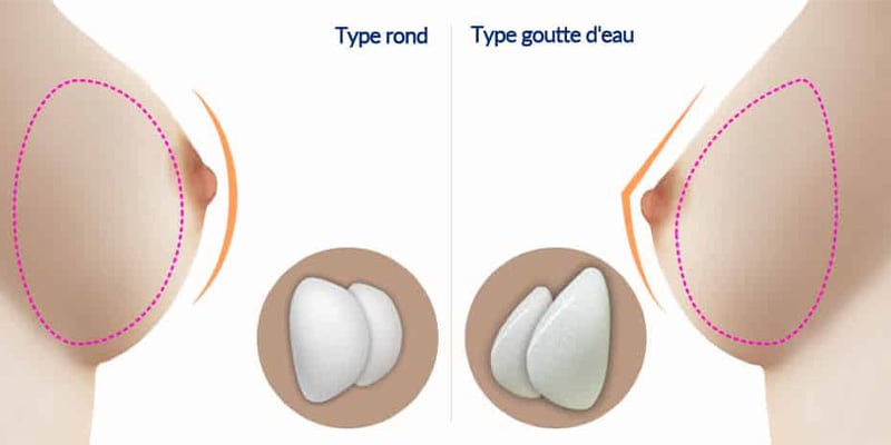 protheses mammaires anatomique ou rondes chirurgie mammaire paris docteur levy jerry chirurgien esthetique paris