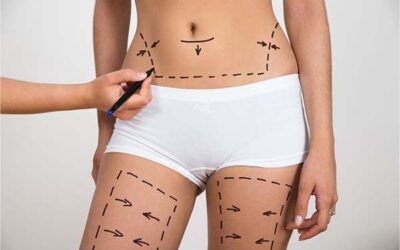 Le Renuvion (ou J-Plasma) pour un lifting sans cicatrices