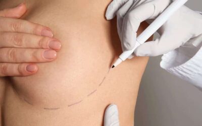 Comment est la cicatrice d&rsquo;un lipofilling mammaire ?
