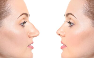 Rhinoplastie : quelles précautions prendre après l&rsquo;opération ?