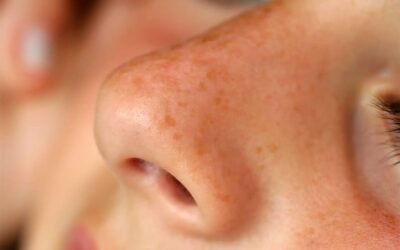 Nez bouché après une rhinoplastie : que faire