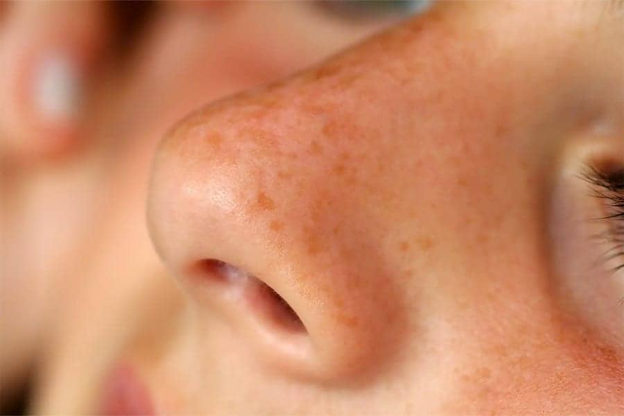 nez bouche apres rhinoplastie que faire chirurgie du nez rhinoplastie paris docteur jerry levy chirurgien esthetique paris