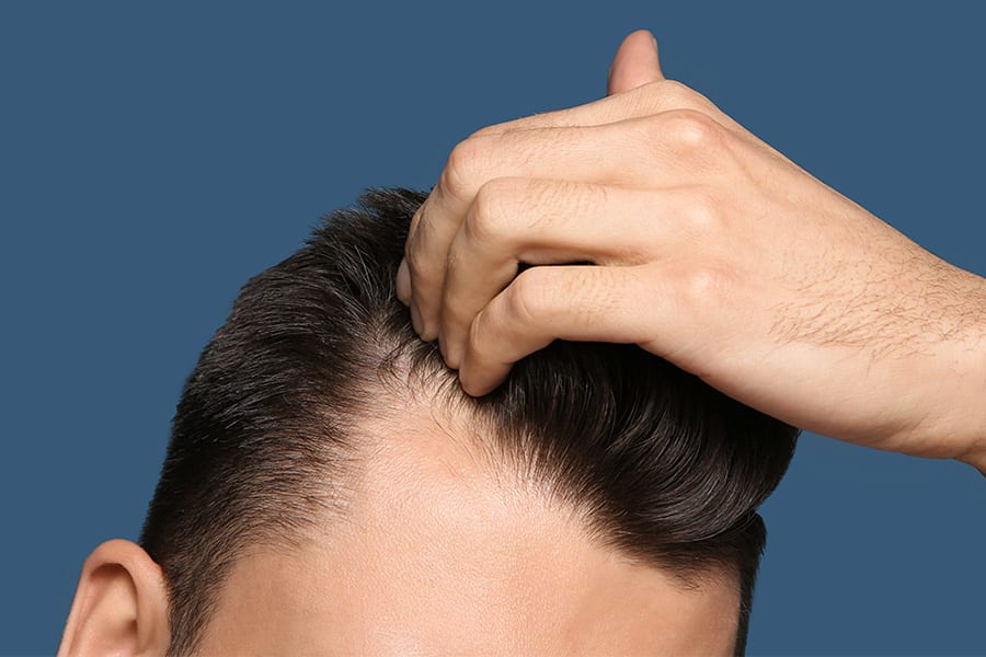 evolution greffe de cheveux apres 20 jours avant apres dr jerry levy chirurgien esthetique paris