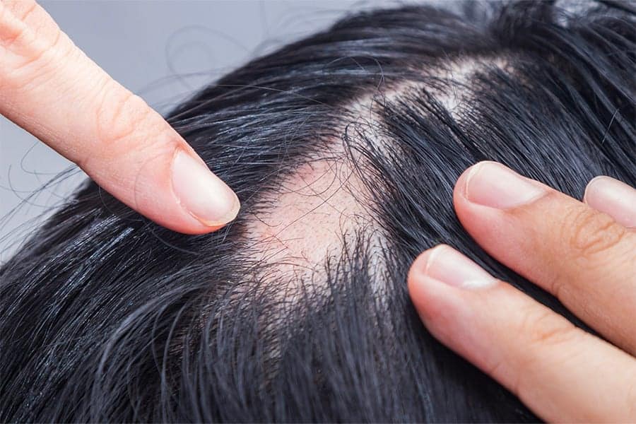 alopecie androgenetique docteur jerry levy chirurgien esthetique specialiste greffe cheveux paris