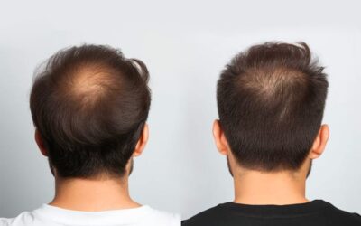 Après une greffe de cheveux, une repousse tardive est-elle normale ?