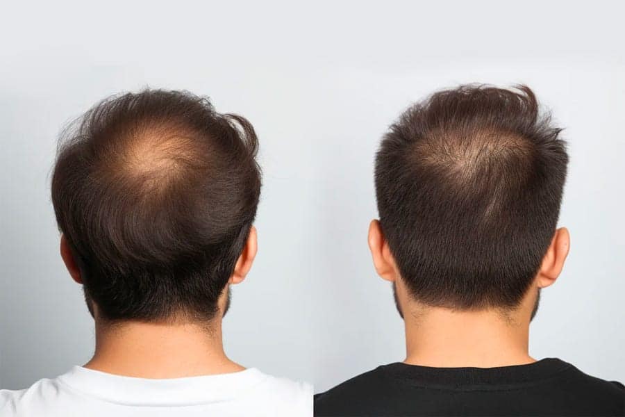 greffe de cheveux repousse docteur jerry levy chirurgien esthetique specialiste greffe cheveux paris