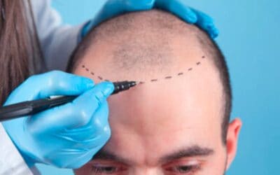 Greffe de cheveux ratée : que faire ?