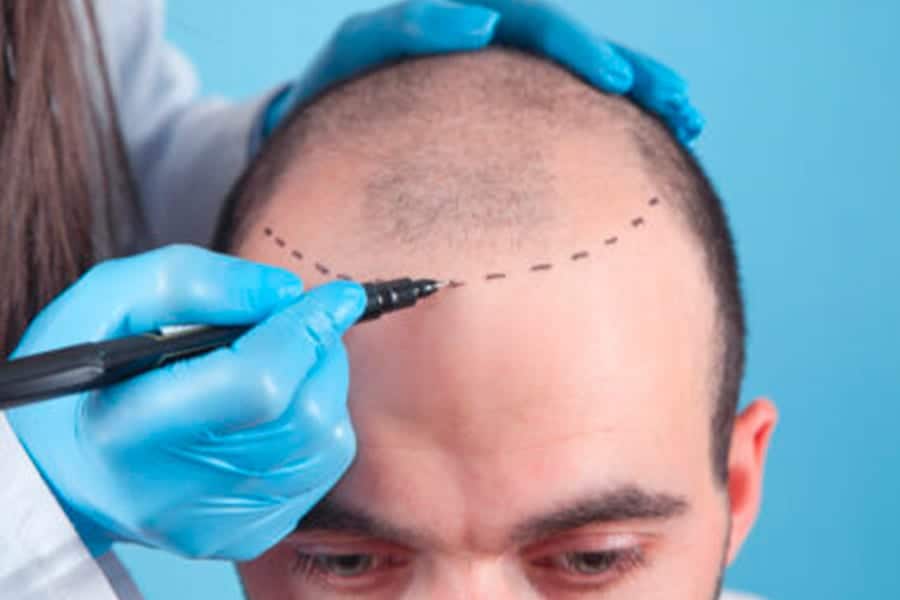 greffe de cheveux ratee docteur jerry levy chirurgien esthetique specialiste greffe cheveux paris