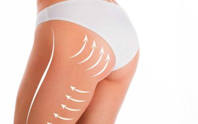 Lipofilling fessier : quelle durée de vie ?