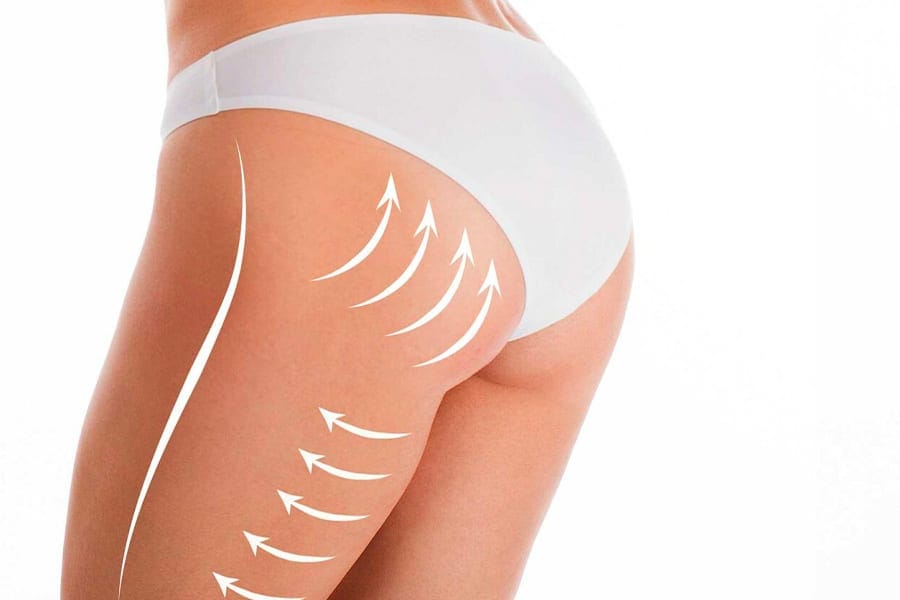 lipofilling fessier duree de vie docteur jerry levy chirurgien esthetique specialiste chirurgie esthetique paris