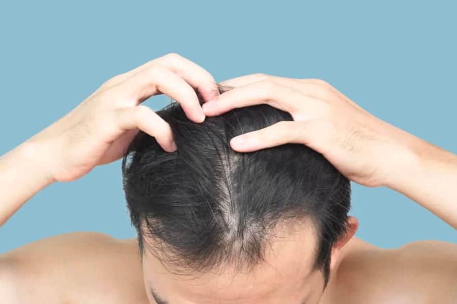 repousse cheveux après greffe docteur jerry levy chirurgien esthetique specialiste medecine esthetique paris