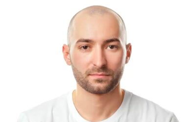 Calvitie chez l&rsquo;homme jeune : quel traitement ?