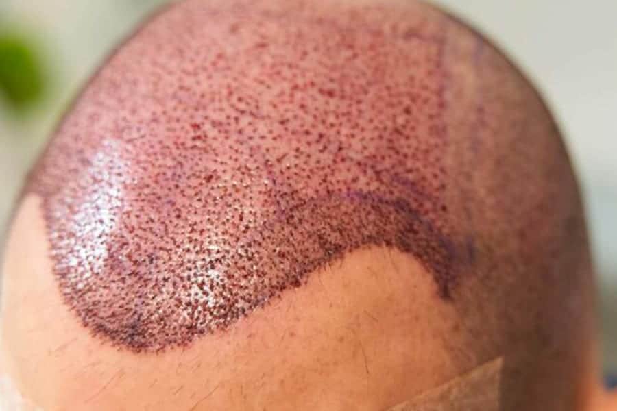 evolution greffe cheveux docteur jerry levy chirurgien esthetique specialiste greffe cheveux paris