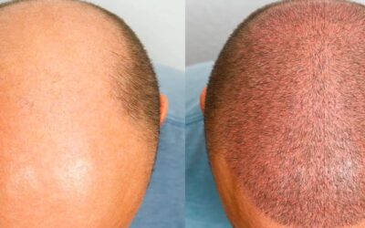 Greffe de cheveux à Paris : tarifs