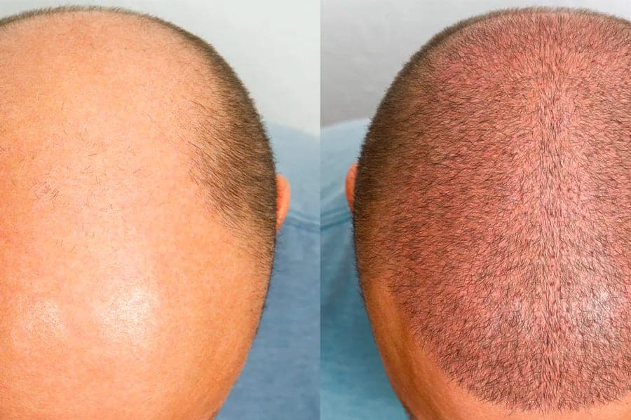 greffe de cheveux paris tarif docteur jerry levy chirurgien esthetique specialiste greffe cheveux paris