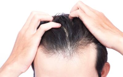 Greffe de cheveux qui ne prend pas : que faire ?