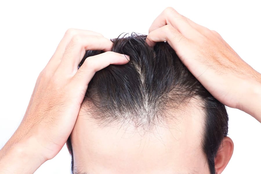 greffe de cheveux qui ne prend pas docteur jerry levy chirurgien esthetique specialiste greffe cheveux paris