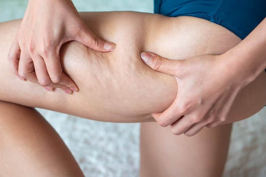 renuvion j plasma cellulite dr jerry levy chirurgien esthetique silhouette paris